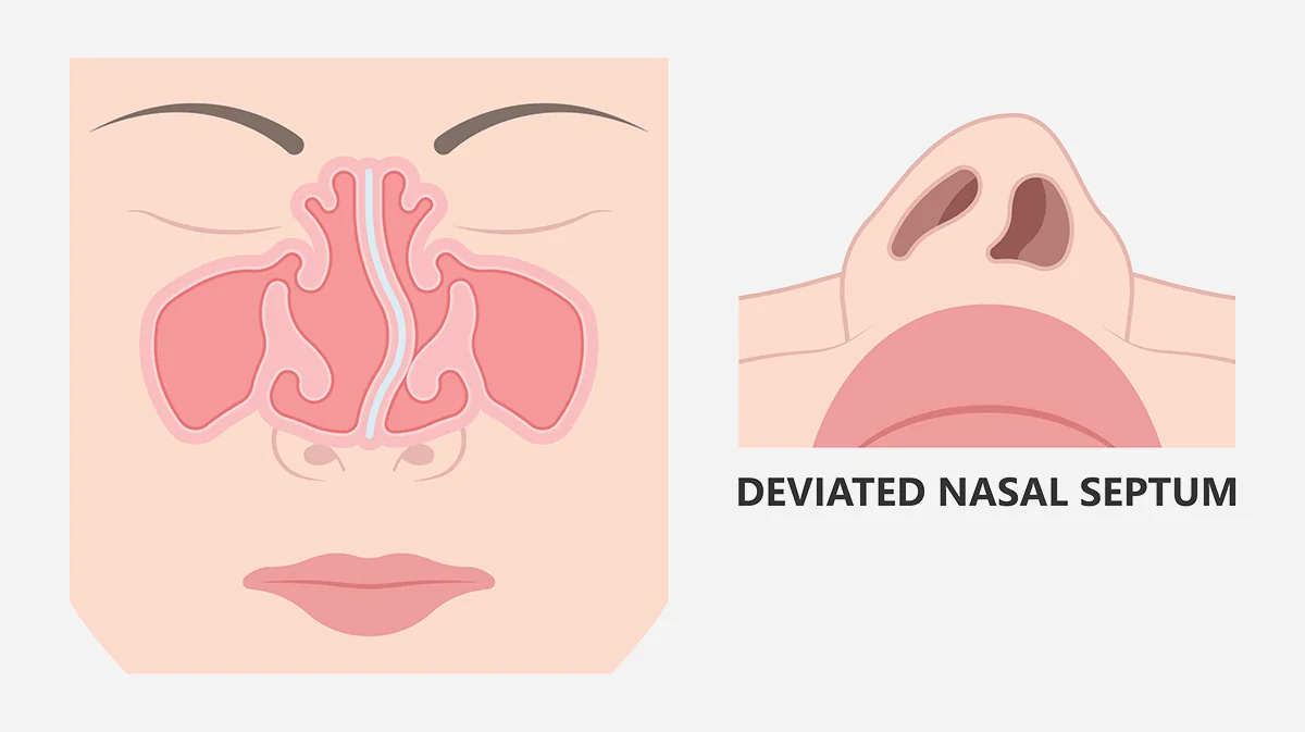 Illustration of a deviated septum