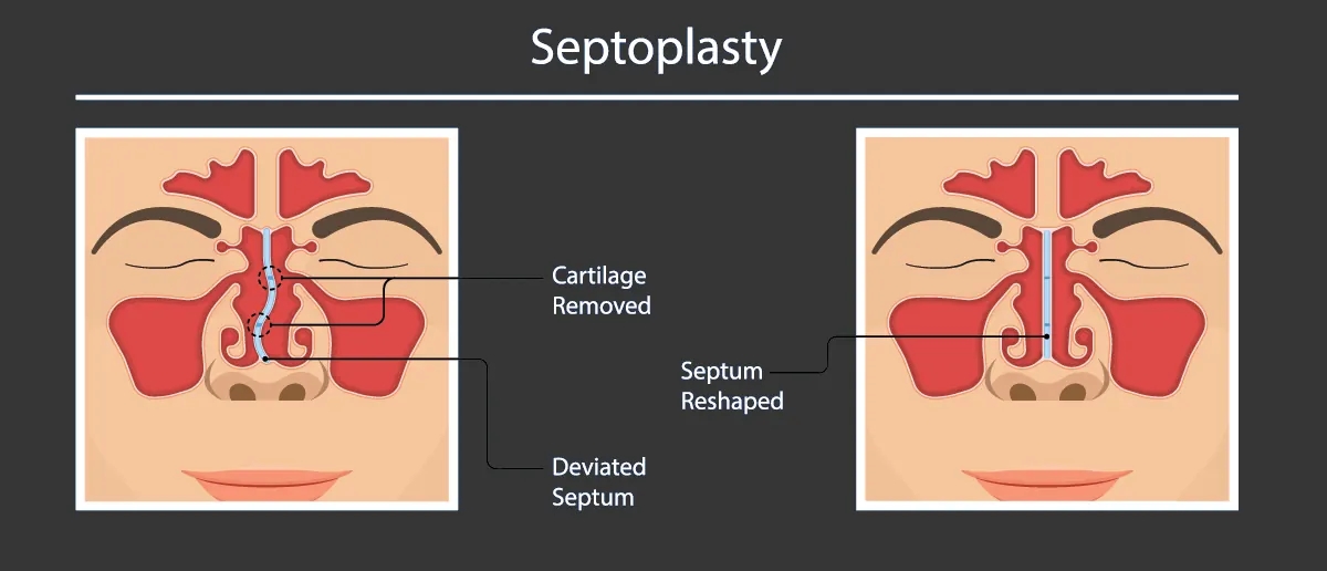 Septoplasty illustration
