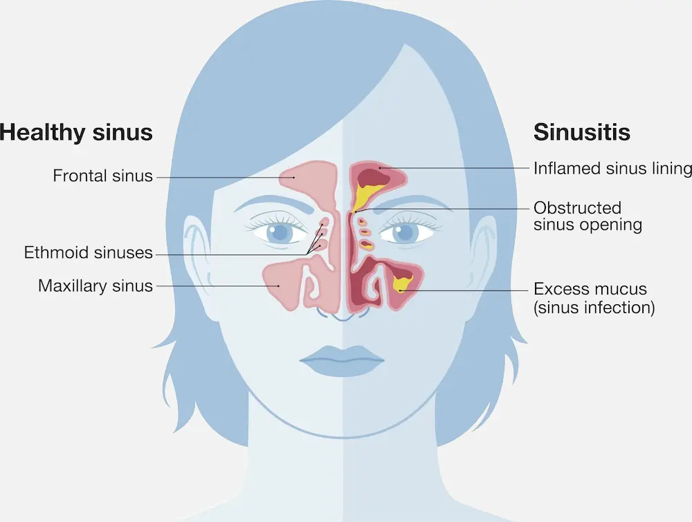 Sinus infection graphic