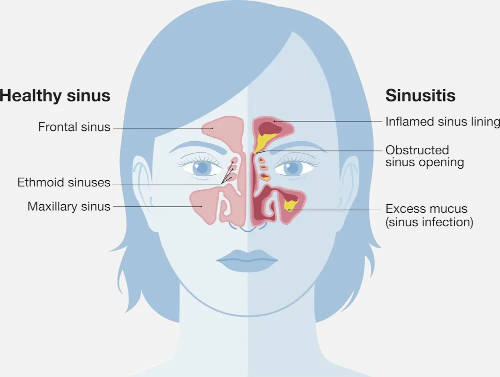 Sinus deals infection smell