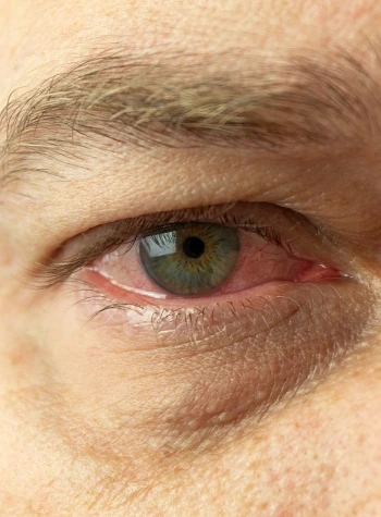closeup of a man's watery eye