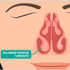 Graphic depicting enlarged Nasal Turbinates