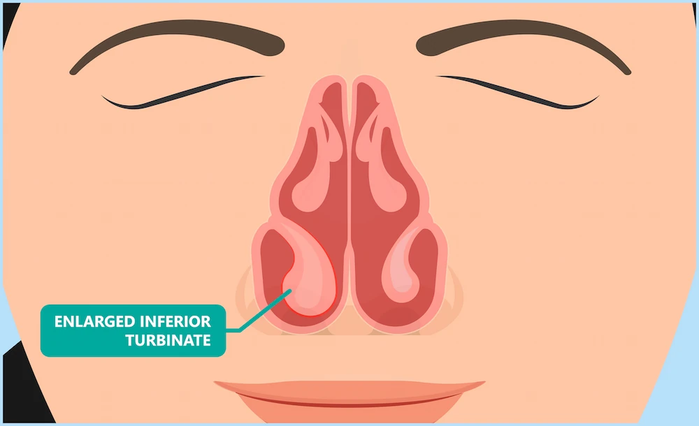 Graphic depicting enlarged Nasal Turbinates